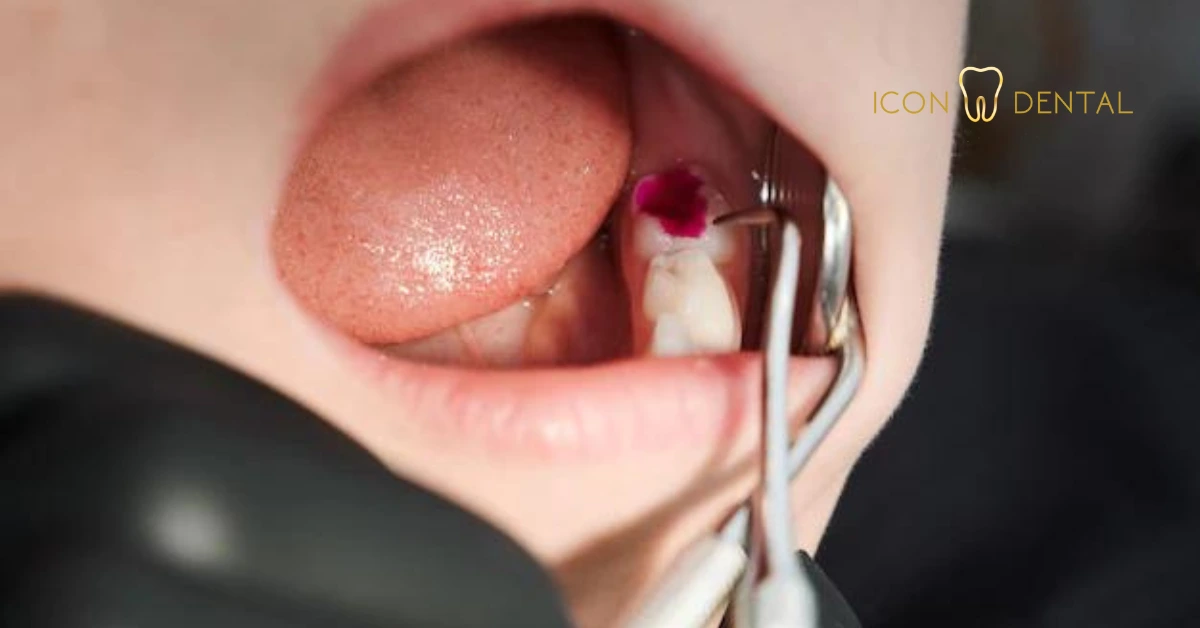 Wisdom Tooth Extraction Balancing Cost and Quality in Malaysia