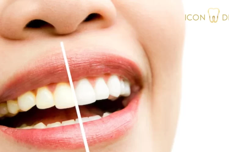 teeth whitening malaysia