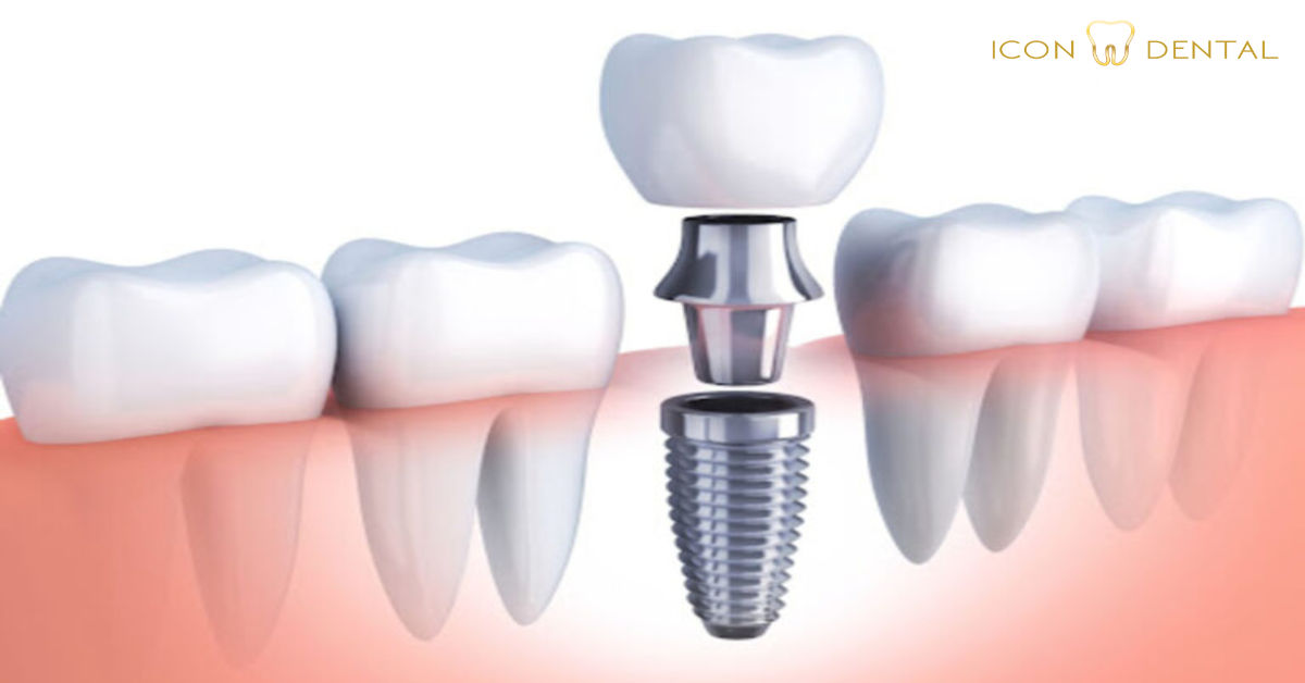 Dental Implants Or Dentures Find Your Best Fit Icon Dental Malaysia