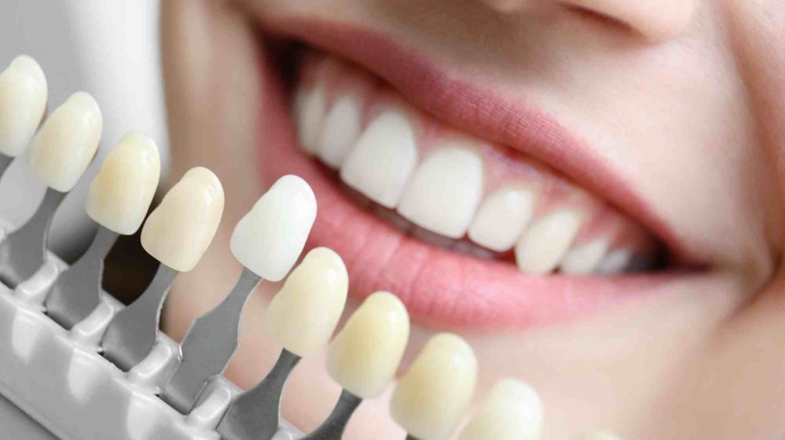 teeth whitening price