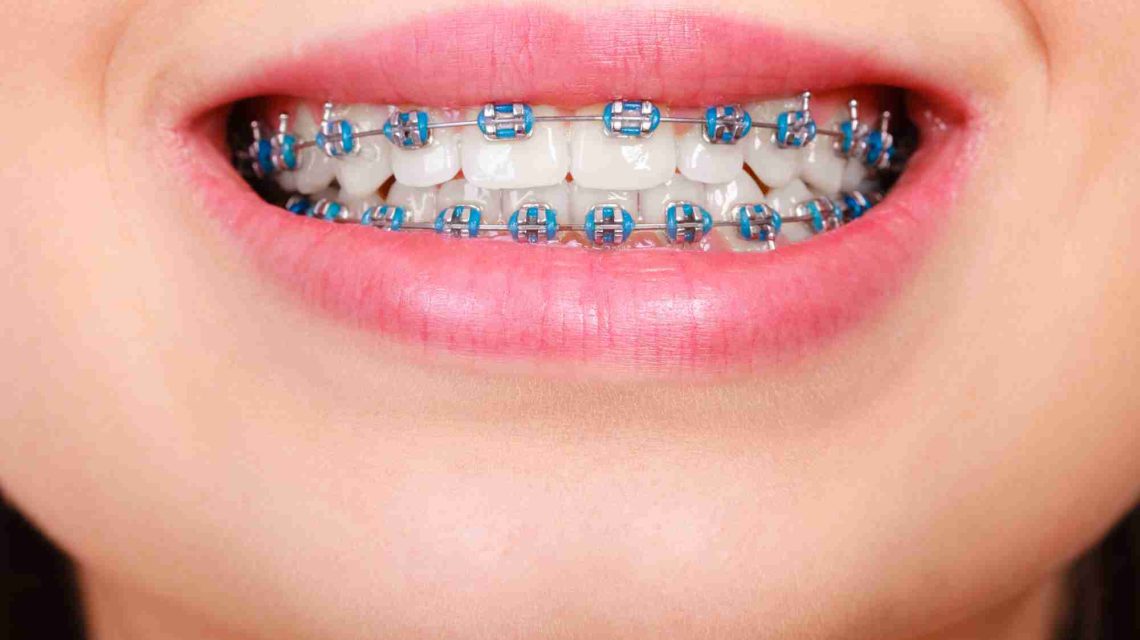 braces price selangor