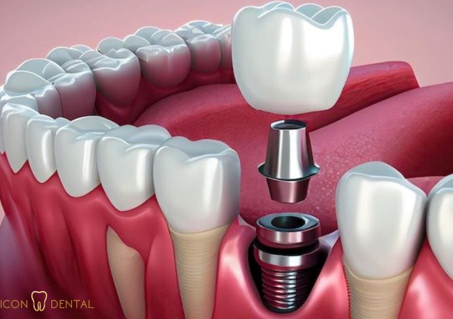 dental implant cost malaysia